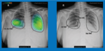 thoracic-suite